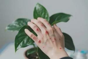 大学生手上长湿疹能自愈吗