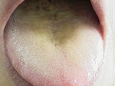 “舌苔”胃气现 察清舌苔再吃饭-第4张图片-就爱百科