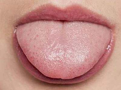 “舌苔”胃气现 察清舌苔再吃饭-第3张图片-就爱百科