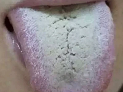 “舌苔”胃气现 察清舌苔再吃饭-第5张图片-就爱百科