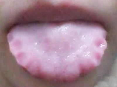 “舌苔”胃气现 察清舌苔再吃饭-第6张图片-就爱百科