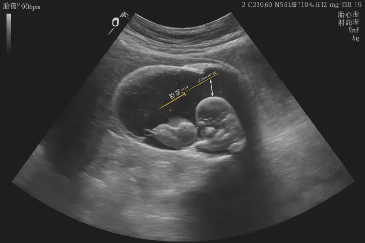 怀孕20多天胎心90左右正常吗(图4)