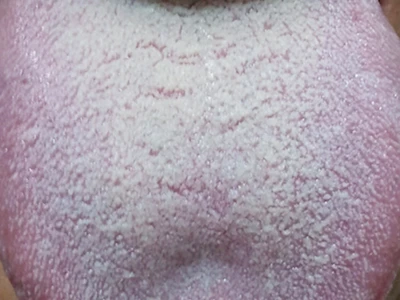 “舌苔”胃气现 察清舌苔再吃饭-第2张图片-就爱百科