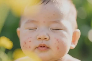 婴儿脸上经常长湿疹能够彻底治愈吗