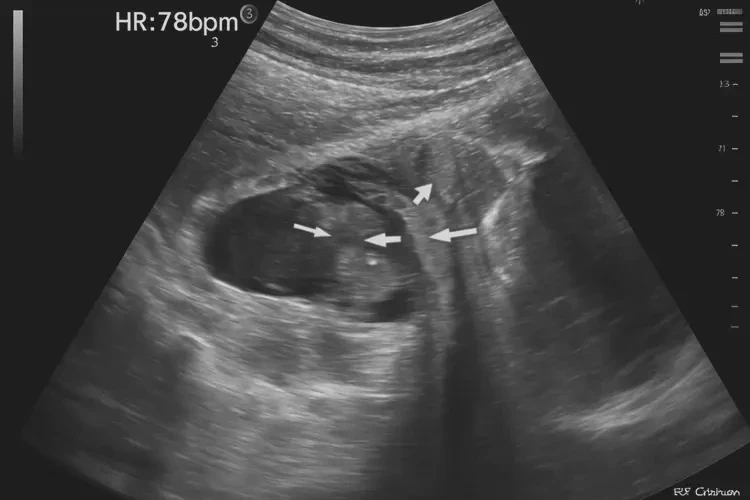 孕18周3天胎心率79怎么回事(图4)