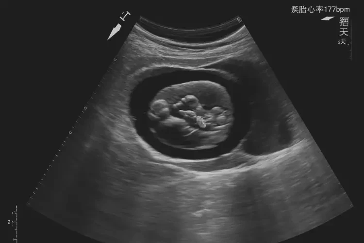 孕5周3天胎心率177还能保住吗(图4)