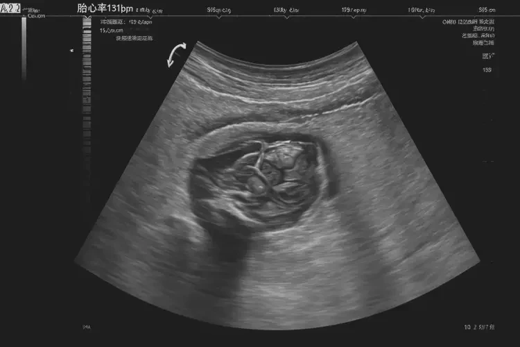 孕15周3天胎心131正常吗(图4)