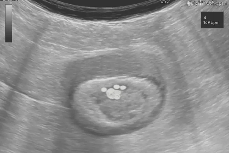 怀孕4周胎心率165怎么回事(图4)