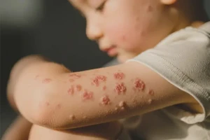 小儿手臂上容易起湿疹不管它会自己好吗