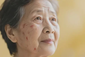 老年人面部有湿疹能靠自己自愈吗