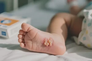 宝宝脚上起湿疹不管它会自己好吗