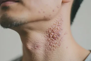 男性脖子上出湿疹可以彻底自愈吗