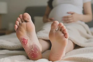 产妇脚上偶尔起湿疹不管它会自己痊愈吗