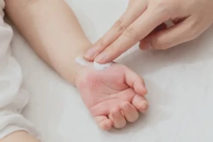 婴幼儿手上偶尔长湿疹能够彻底治愈吗