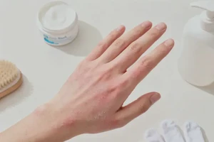 男人手上容易长湿疹能不能彻底自愈