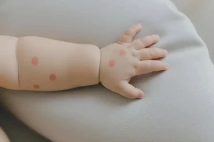 婴儿手臂偶尔长湿疹能够彻底治愈吗