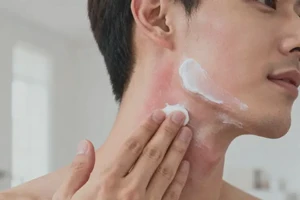 男人脖子经常长湿疹可以彻底自愈吗