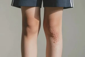 中学生大腿上起湿疹能靠自己自愈吗