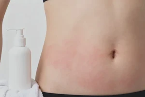 女生肚子容易长湿疹不管它会自己痊愈吗