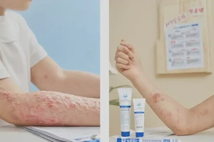 少儿身上有湿疹可不可以彻底自愈