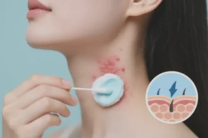 女人脖子上经常长湿疹可以彻底自愈吗