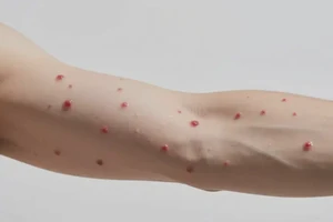 男性手臂偶尔长湿疹不管它会自己痊愈吗