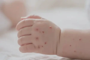 宝宝手上起湿疹不管它会自己好吗