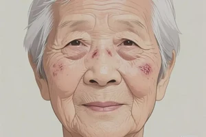 老人面部起湿疹不管它会自己好吗