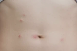 女人肚子容易长湿疹不管它会自己好吗