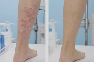 女性脚上经常起湿疹不管它会自己自愈吗