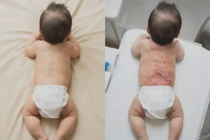 婴儿屁股上容易长湿疹能靠自己自愈吗