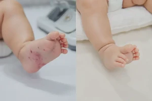 宝宝脚上偶尔长湿疹可不可以彻底自愈