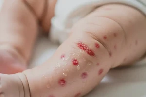 婴儿大腿上起湿疹可不可以根治