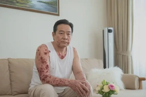 男性手臂上容易长湿疹能彻底自愈吗