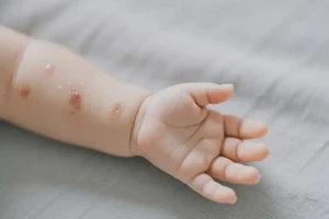 宝宝手臂上长湿疹可不可以根治