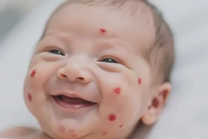 新生儿脸上出湿疹不管它会自己好吗