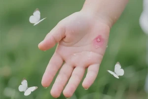 孩子手上容易起湿疹可以彻底自愈吗