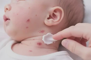 新生儿脖子偶尔起湿疹可以彻底自愈吗