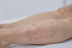 少儿大腿有湿疹不管它会自己好吗