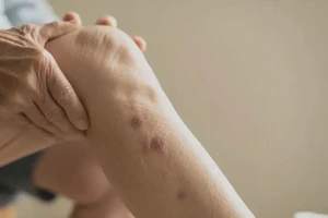 老人大腿出湿疹能彻底自愈吗