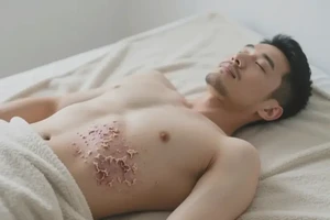 男人肚子上有湿疹能不能根治