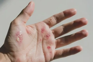 男人手上偶尔起湿疹不管它会自己好吗