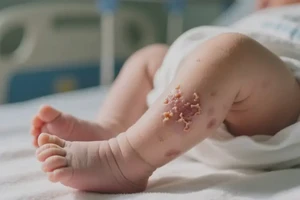 新生儿小腿上容易长湿疹不管它会自己痊愈吗