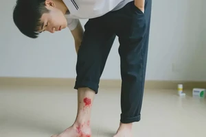 大学生脚上经常起湿疹不管它会自己自愈吗