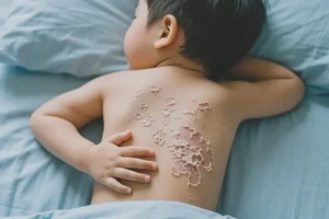 小孩身上起湿疹可不可以彻底自愈