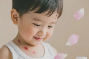 小孩脖子偶尔长湿疹能够彻底治愈吗