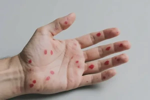 男生手上偶尔起湿疹不管它会自己好吗