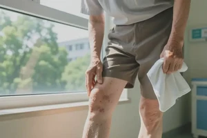 老人大腿上偶尔长湿疹能够彻底治愈吗