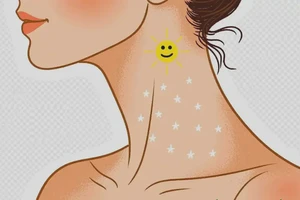 女生脖子上经常长湿疹可不可以彻底自愈